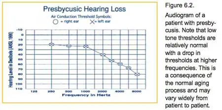 presbycusis
