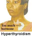 Thyroid Dysfunction and Tinnitus