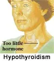 Thyroid Dysfunction and Tinnitus