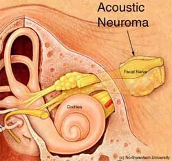 A diagram of the ear showcasing acoustic neuroma and how it relates to tinnitus.