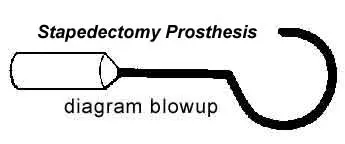 Stapedectomy for Otosclerosis