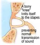 Hormonal Changes in Women & Tinnitus