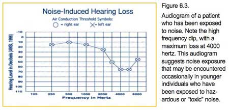 noise-induced hearing loss