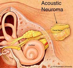 A diagram of the ear showcasing acoustic neuroma and how it relates to tinnitus.