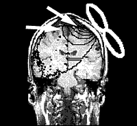 Transcranial Magnetic Stimulation for Tinnitus