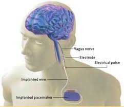 Shows placement of vagus nerve in humans.