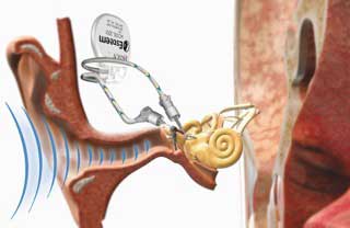 Fully Implantable Hearing Aid