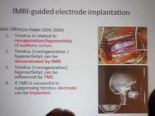 AAO-HNSF International Tinnitus Mini-Seminar – 2012