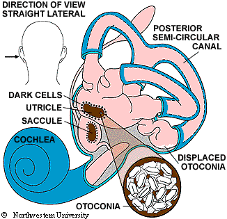How BBPV grahpic of inner ear